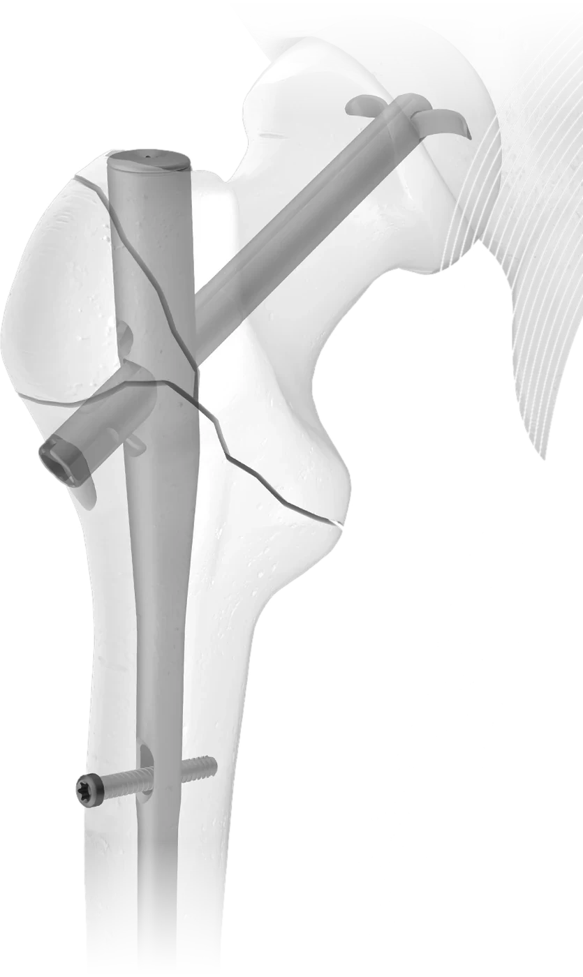 Hansson DCN in the proximal femur